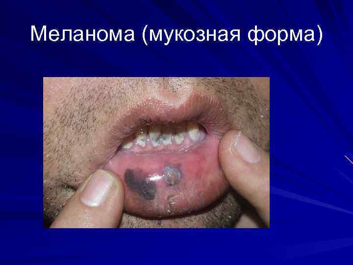 Меланома (мукозная форма) 