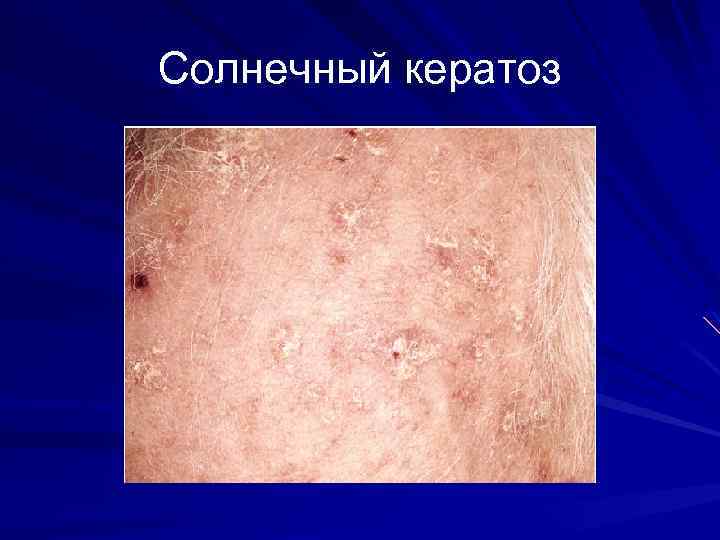 Солнечный кератоз 