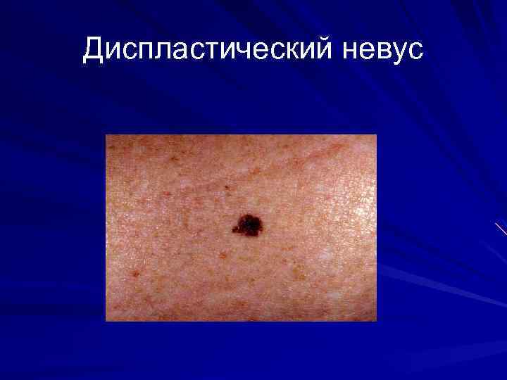 Диспластический невус 