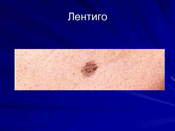 Лентиго 