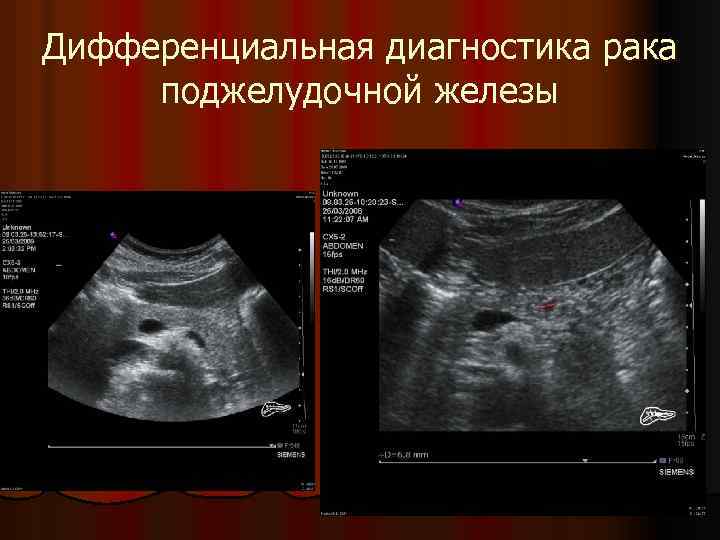 Дифференциальная диагностика рака поджелудочной железы 