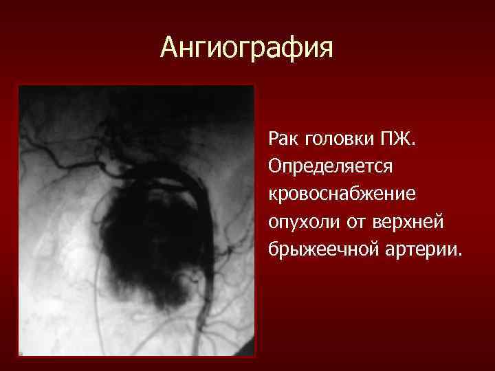 Ангиография Рак головки ПЖ. Определяется кровоснабжение опухоли от верхней брыжеечной артерии. 