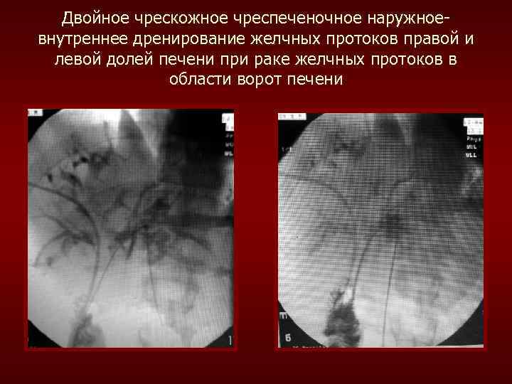 Двойное чрескожное чреспеченочное наружноевнутреннее дренирование желчных протоков правой и левой долей печени при раке