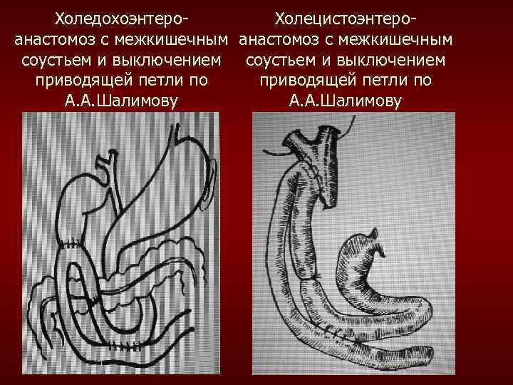 Холедохоэнтеро. Холецистоэнтероанастомоз с межкишечным соустьем и выключением приводящей петли по А. А. Шалимову 