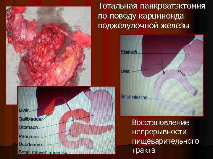 Тотальная панкреатэктомия по поводу карциноида поджелудочной железы Восстановление непрерывности пищеварительного тракта 