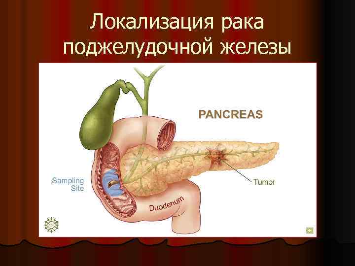 Локализация рака поджелудочной железы 