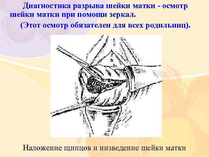 Диагностика разрыва шейки матки осмотр шейки матки при помощи зеркал. (Этот осмотр обязателен для