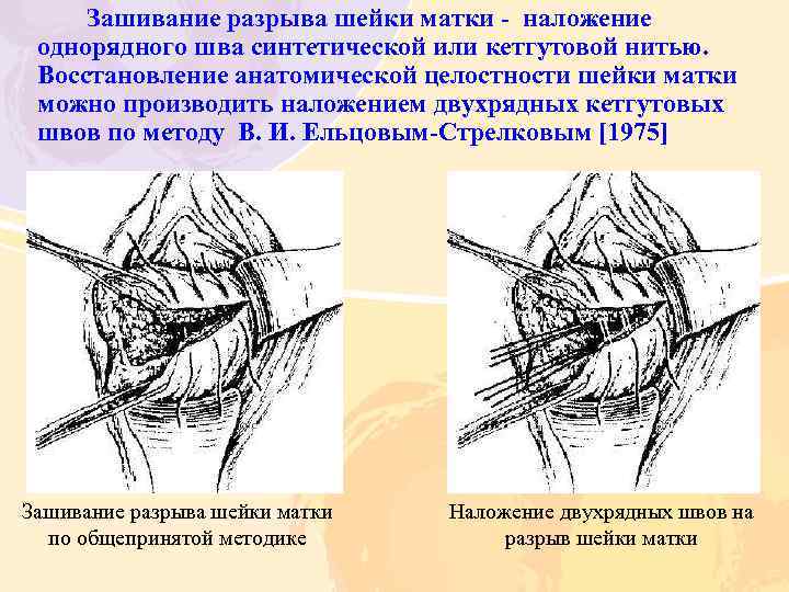 Зашивание разрыва шейки матки наложение однорядного шва синтетической или кетгутовой нитью. Восстановление анатомической целостности