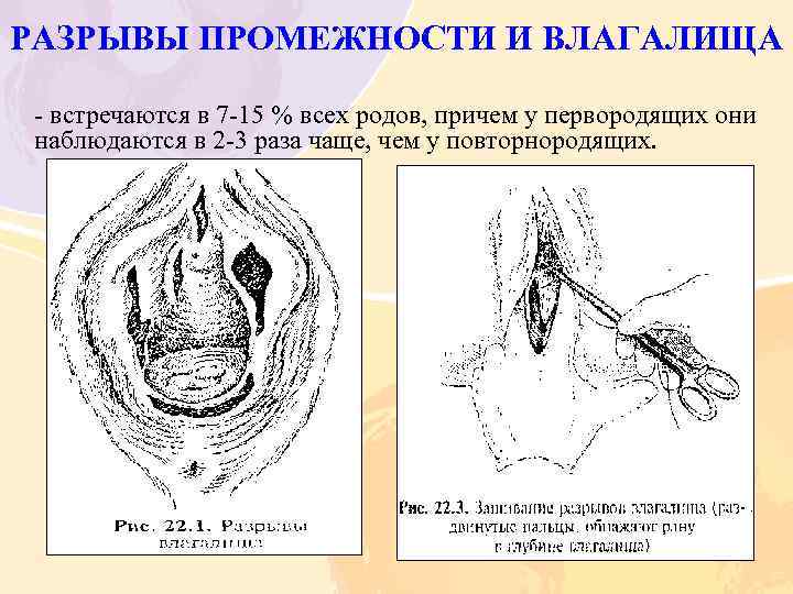 РАЗРЫВЫ ПРОМЕЖНОСТИ И ВЛАГАЛИЩА - встречаются в 7 -15 % всех родов, причем у