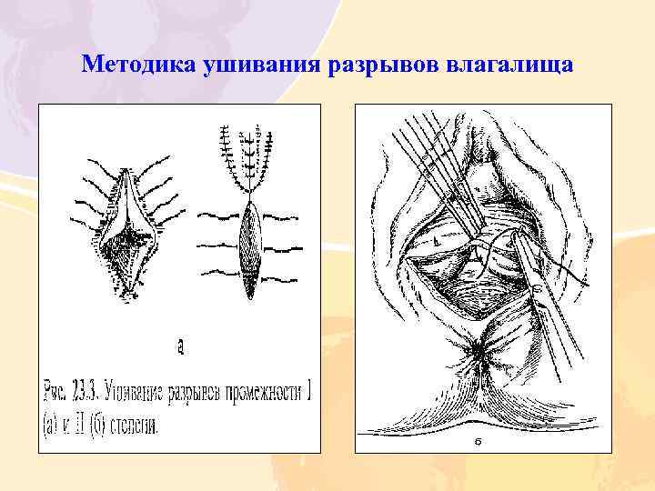 Методика ушивания разрывов влагалища 