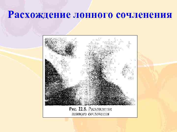 Расхождение лонного сочленения 