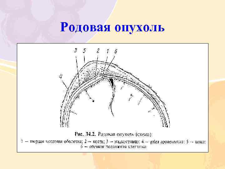 Родовая опухоль 