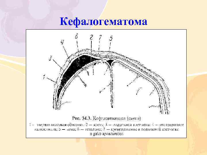 Кефалогематома 