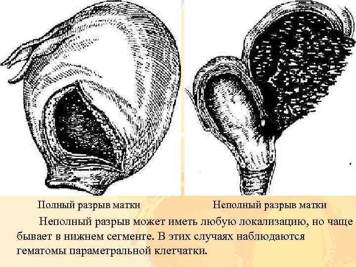 Полный разрыв матки Неполный разрыв может иметь любую локализацию, но чаще бывает в нижнем