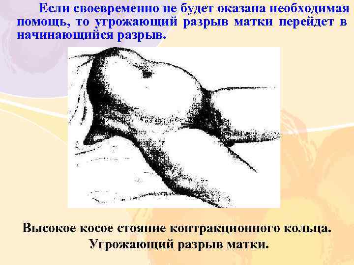 Если своевременно не будет оказана необходимая помощь, то угрожающий разрыв матки перейдет в начинающийся