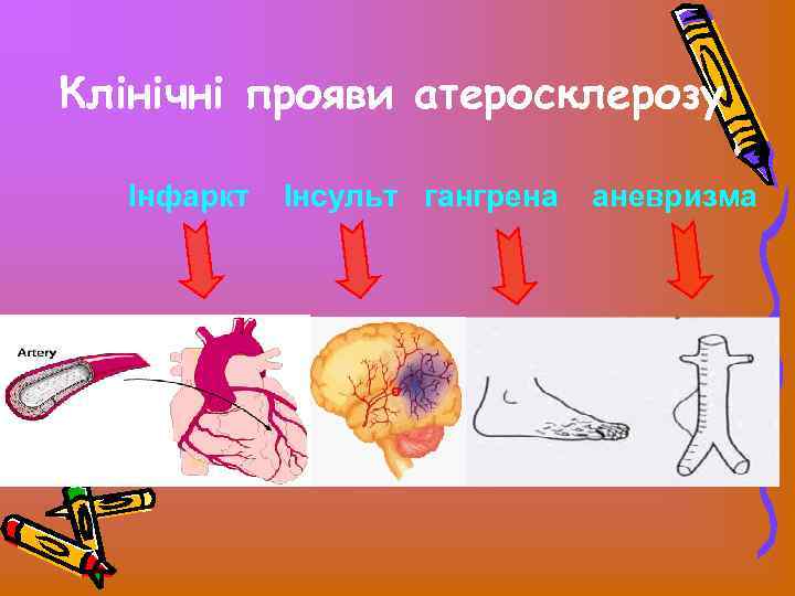 Клінічні прояви атеросклерозу Інфаркт Інсульт гангрена аневризма 
