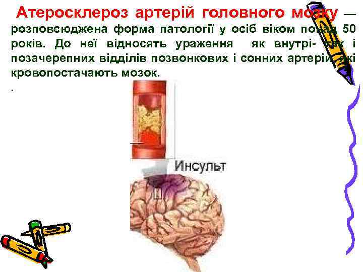 Атеросклероз артерій головного мозку — розповсюджена форма патології у осіб віком понад 50 років.
