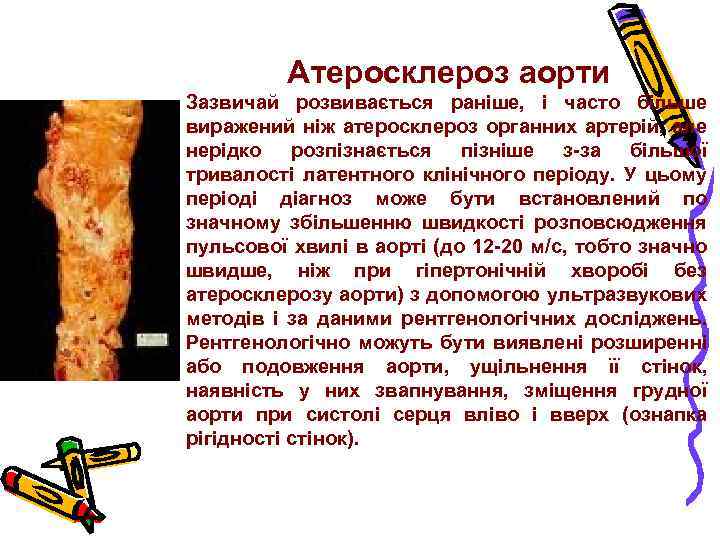 Атеросклероз аорти Зазвичай розвивається раніше, і часто більше виражений ніж атеросклероз органних артерій, але