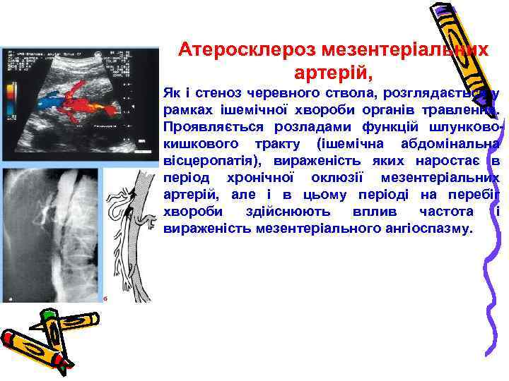 Атеросклероз мезентеріальних артерій, Як і стеноз черевного ствола, розглядається у рамках ішемічної хвороби органів