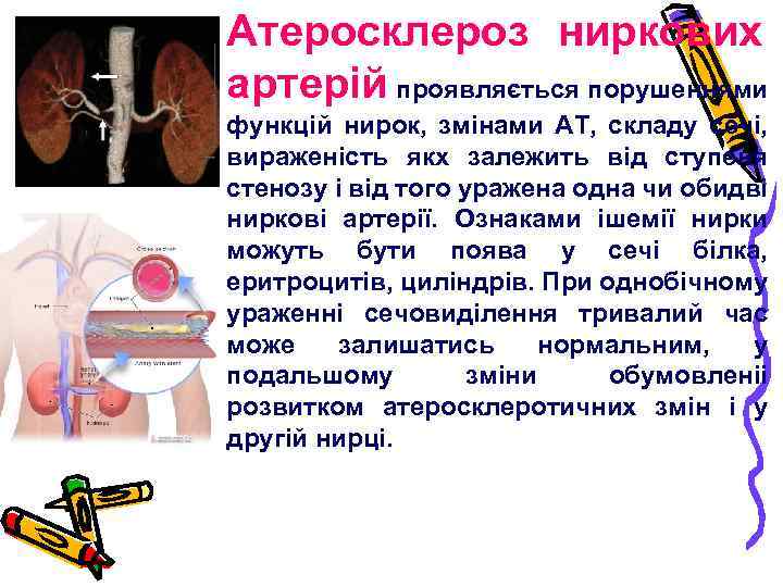 Атеросклероз ниркових артерій проявляється порушеннями функцій нирок, змінами АТ, складу сечі, вираженість якх залежить