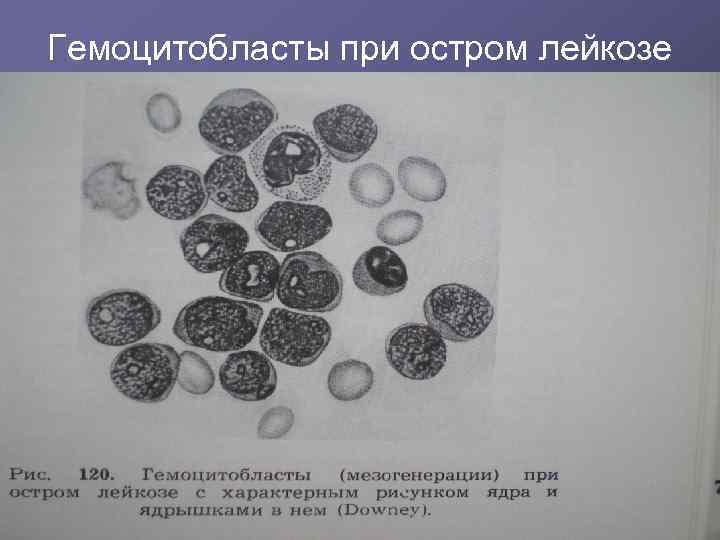 Гемоцитобласты при остром лейкозе 