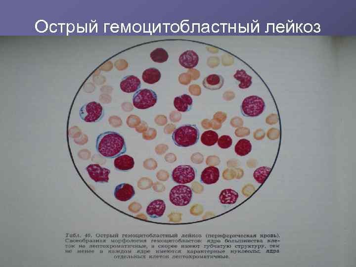 Острый гемоцитобластный лейкоз 