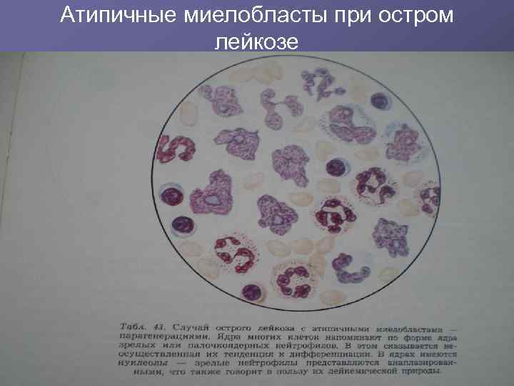 Атипичные миелобласты при остром лейкозе 