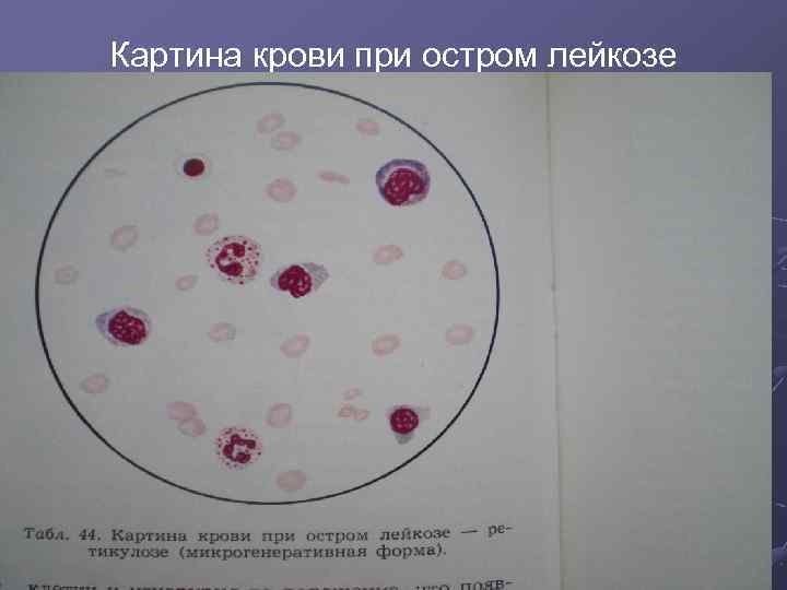 Картина крови при лейкозах