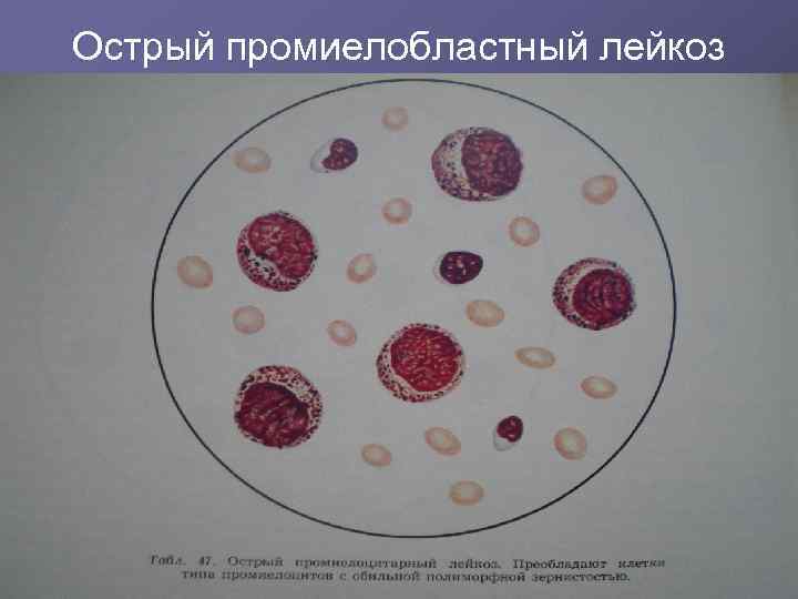 Острый промиелобластный лейкоз 