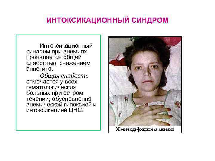 ИНТОКСИКАЦИОННЫЙ СИНДРОМ Интоксикационный синдром при анемиях проявляется общей слабостью, снижением аппетита. Общая слабость отмечается