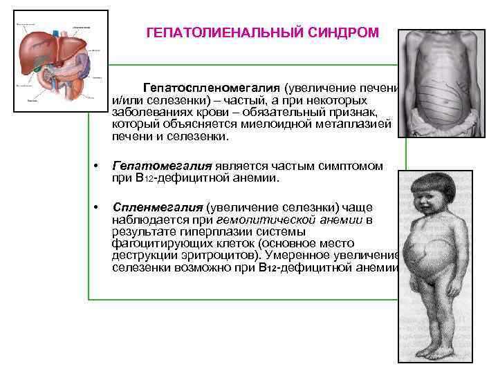 Гепатолиенальный синдром картинки