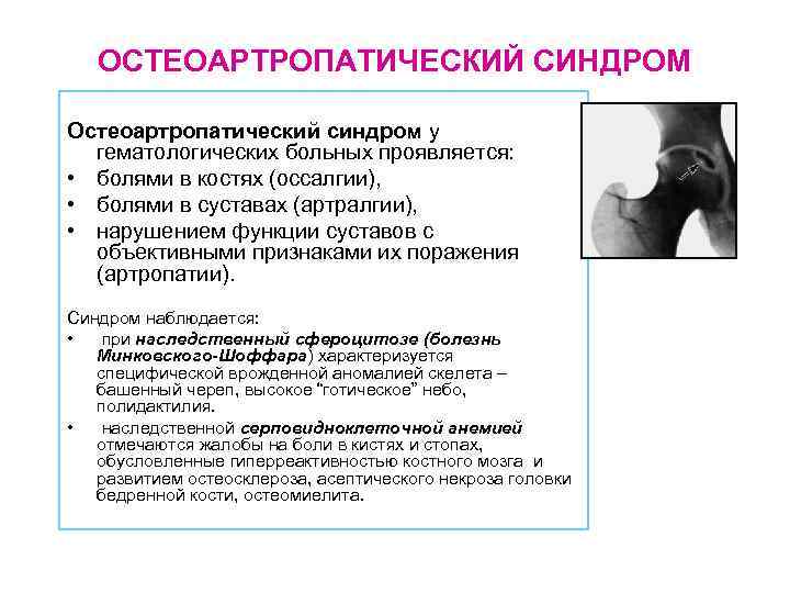 ОСТЕОАРТРОПАТИЧЕСКИЙ СИНДРОМ Остеоартропатический синдром у гематологических больных проявляется: • болями в костях (оссалгии), •
