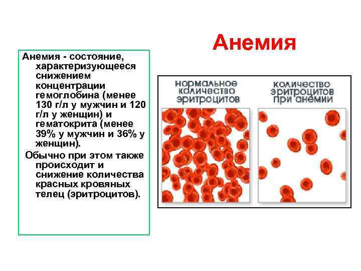 Снижение гемоглобина у мужчин. Анемия и пониженный гемоглобин. Малокровие это низкий гемоглобин. Месячные при железодефицитной анемии. Гемоглобин при анемии.