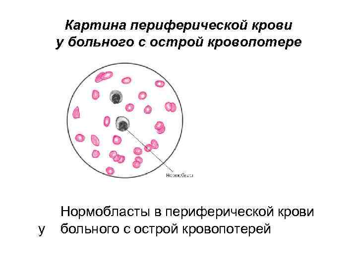 Нормоцит это. Эритро-, нормобласты. Появление нормобластов в периферической крови. Нормоциты в крови норма. Нормоциты в крови норма у взрослого.