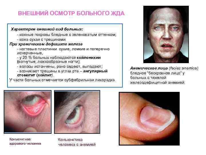 ВНЕШНИЙ ОСМОТР БОЛЬНОГО ЖДА Характерен внешний вид больных: - кожные покровы бледные с зеленоватым