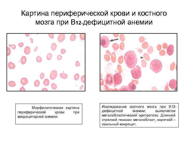 Картина крови при анемии