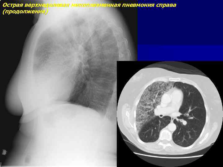 Острая верхнедолевая микоплазменная пневмония справа (продолжение) 