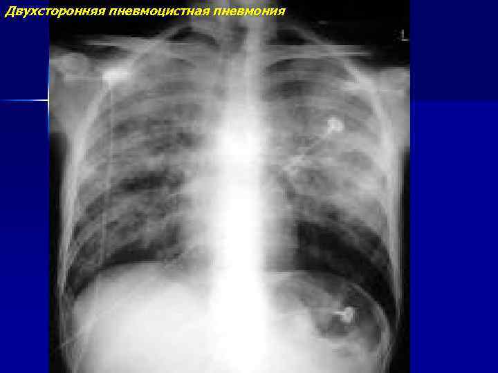 Двухсторонняя пневмоцистная пневмония 