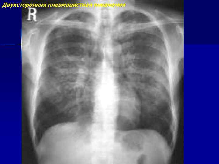 Двухсторонняя пневмоцистная пневмония 