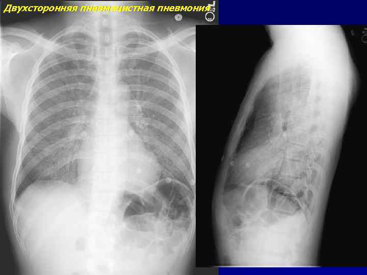 Двухсторонняя пневмоцистная пневмония 