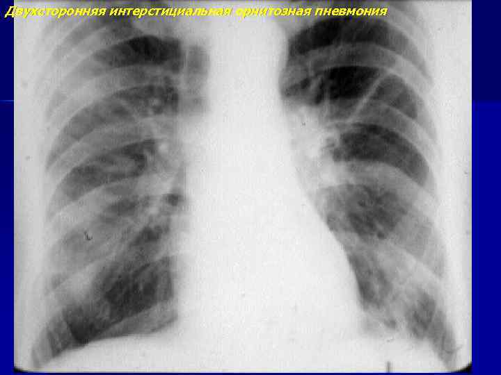 Двухсторонняя интерстициальная орнитозная пневмония 