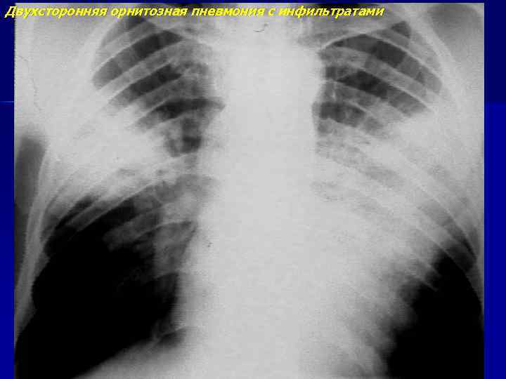 Двухсторонняя орнитозная пневмония с инфильтратами 