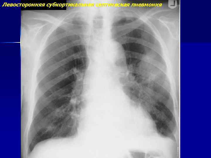 Левосторонняя субкортикальная септическая пневмония 