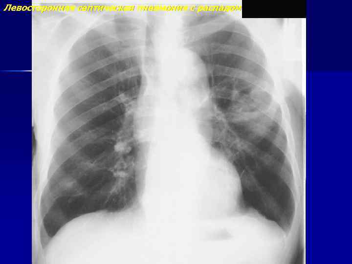 Левосторонняя септическая пневмония с распадом 