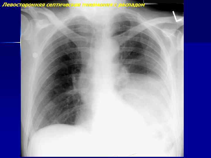Левосторонняя септическая пневмония с распадом 