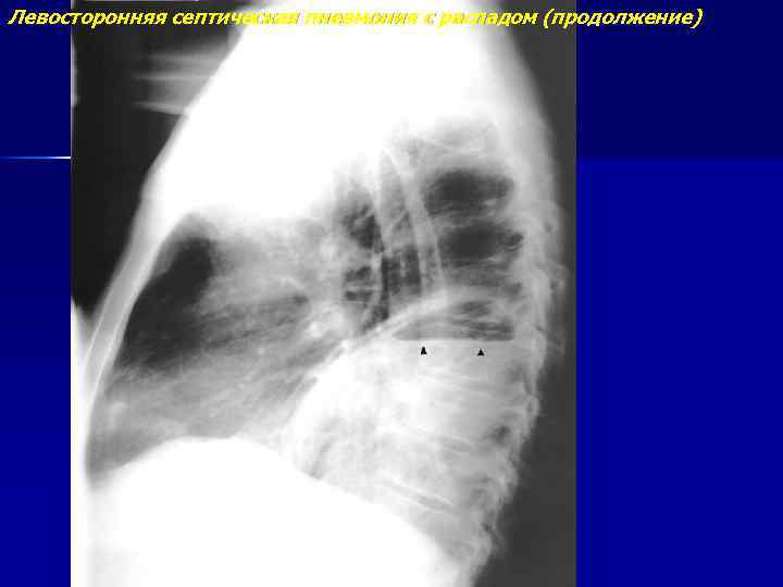 Левосторонняя септическая пневмония с распадом (продолжение) 