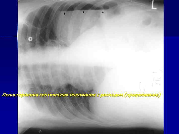 Левосторонняя септическая пневмония с распадом (продолжение) 
