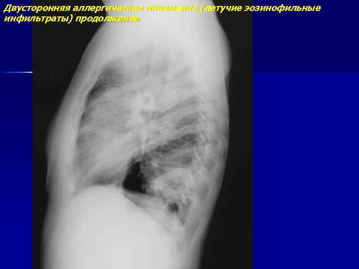Двусторонняя аллергическая пневмония (летучие эозинофильные инфильтраты) продолжение 