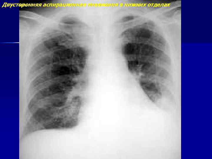 Двусторонняя аспирационная пневмония в нижних отделах 