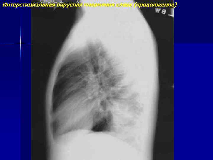 Интерстициальная вирусная пневмония слева (продолжение) 